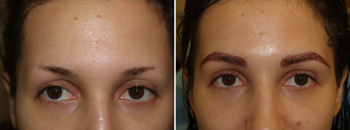 Eyebrow Transplantation before and after photos in Miami, FL, Patient 16443