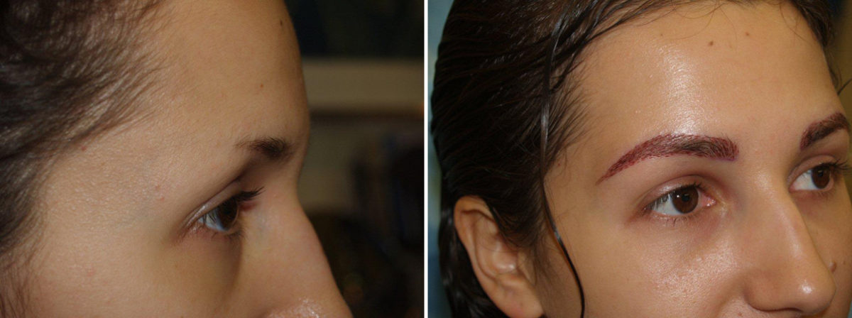 Eyebrow Transplantation before and after photos in Miami, FL, Patient 16443