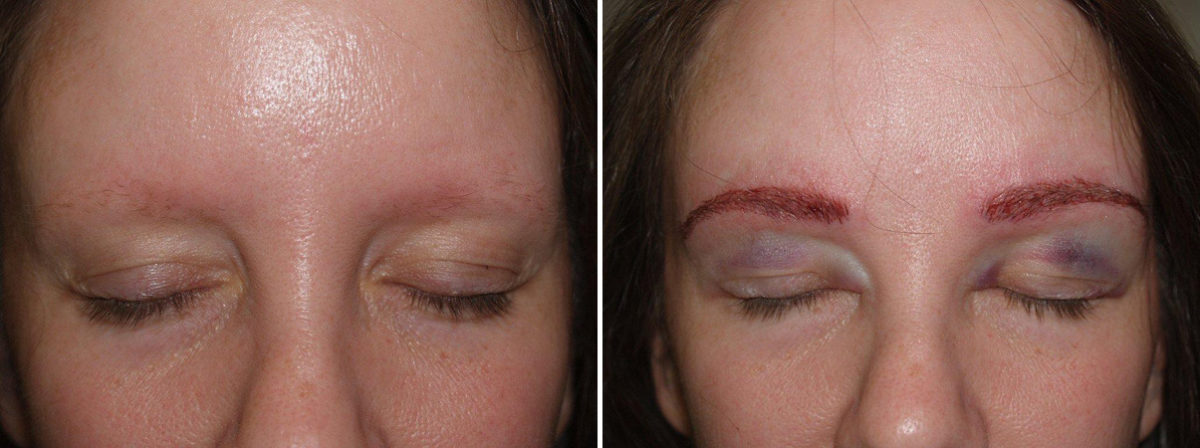 Eyebrow Transplantation before and after photos in Miami, FL, Patient 16445