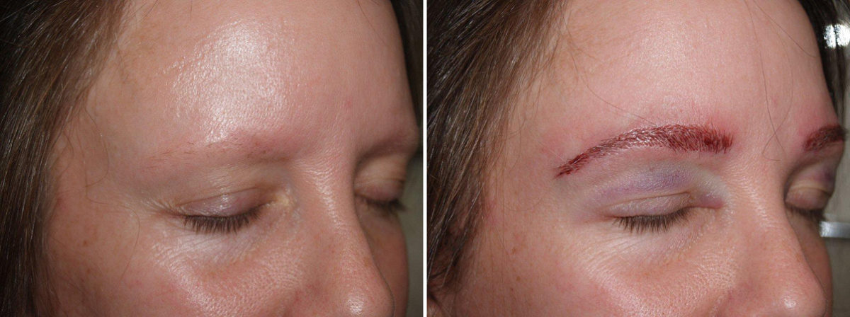 Eyebrow Transplantation before and after photos in Miami, FL, Patient 16445