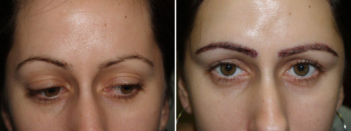 Eyebrow Transplantation before and after photos in Miami, FL, Patient 16452