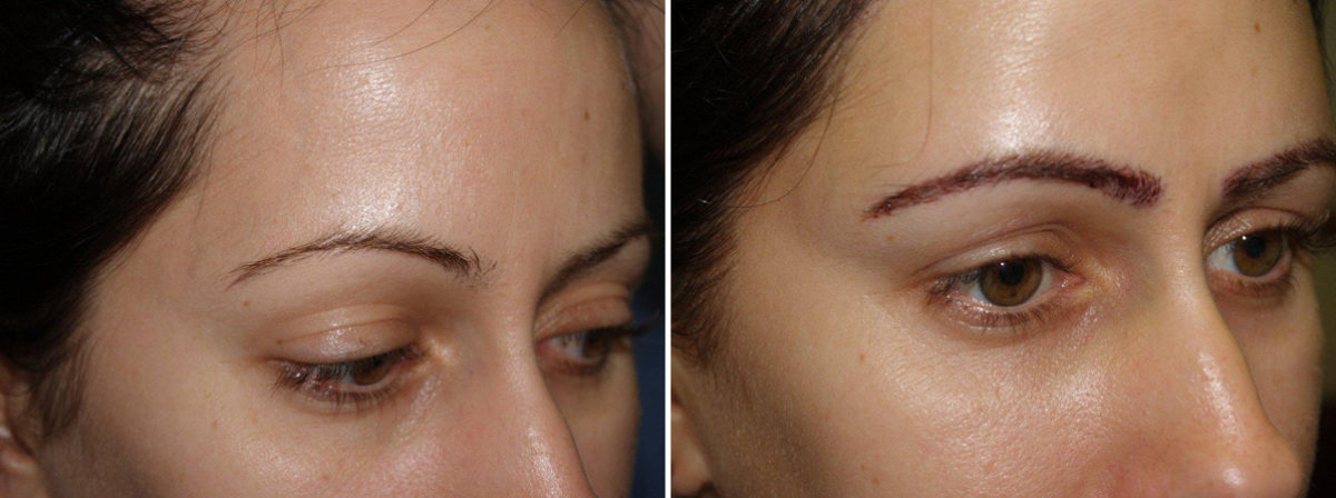 Eyebrow Transplantation before and after photos in Miami, FL, Patient 16452