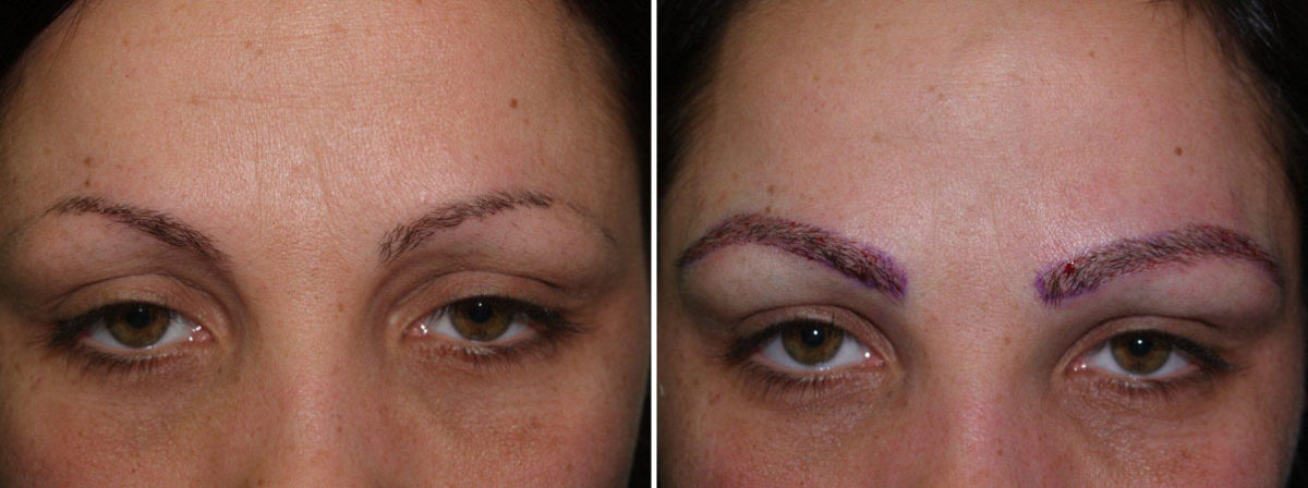 Eyebrow Transplantation before and after photos in Miami, FL, Patient 16473