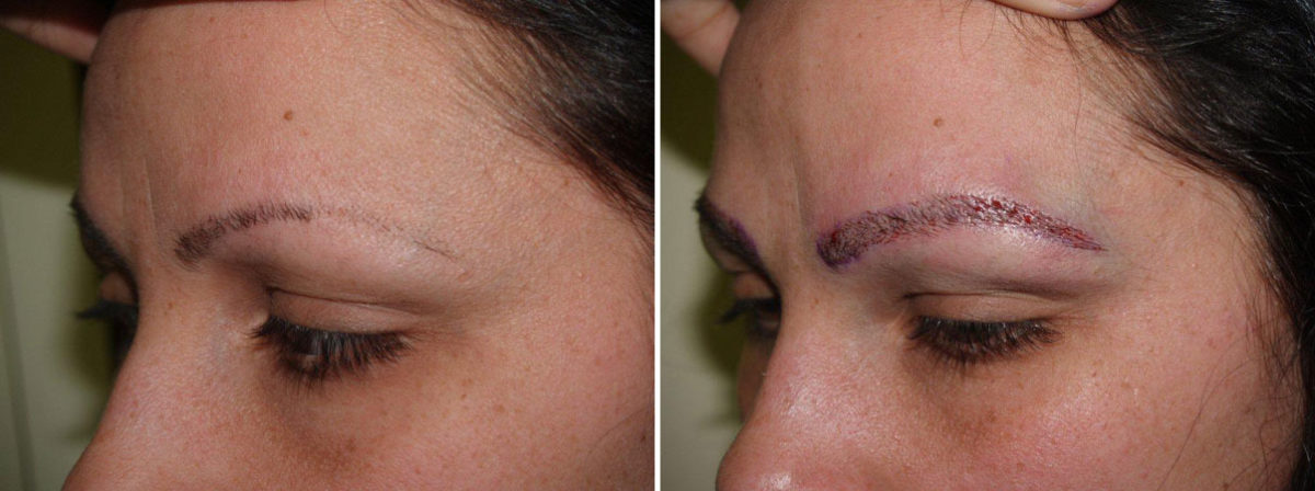 Eyebrow Transplantation before and after photos in Miami, FL, Patient 16473