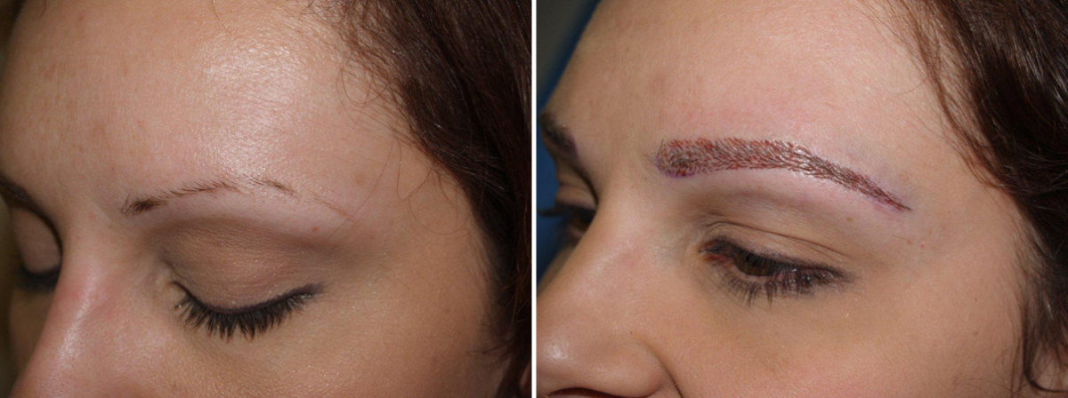 Eyebrow Transplantation before and after photos in Miami, FL, Patient 16480