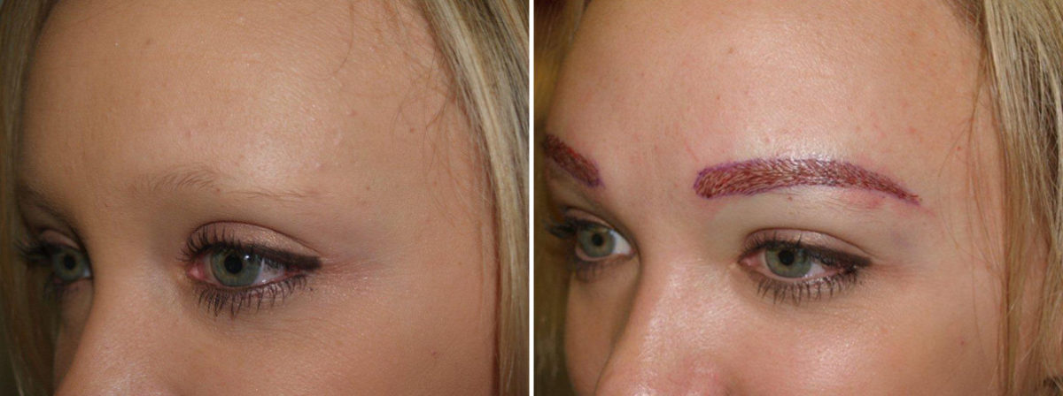 Eyebrow Transplantation before and after photos in Miami, FL, Patient 16487