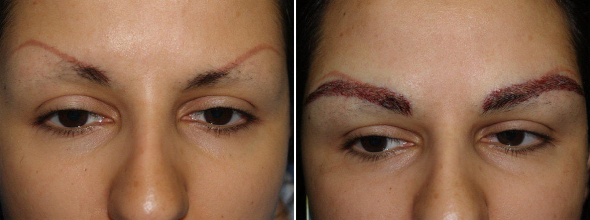 Eyebrow Transplantation before and after photos in Miami, FL, Patient 16492