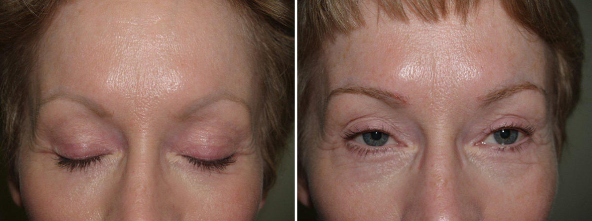 Eyebrow Transplantation before and after photos in Miami, FL, Patient 16502
