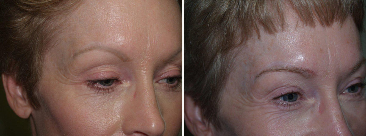 Eyebrow Transplantation before and after photos in Miami, FL, Patient 16502