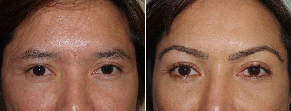 Eyebrow Transplantation before and after photos in Miami, FL, Patient 16519