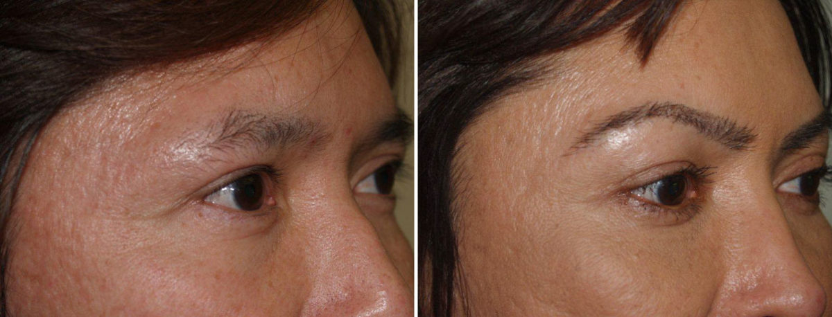 Eyebrow Transplantation before and after photos in Miami, FL, Patient 16519