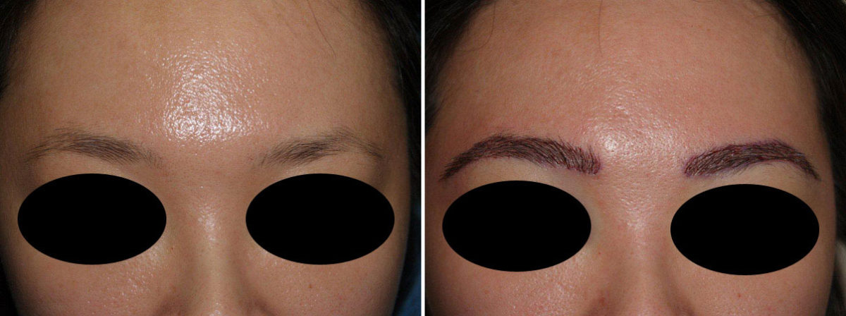 Eyebrow Transplantation before and after photos in Miami, FL, Patient 16529