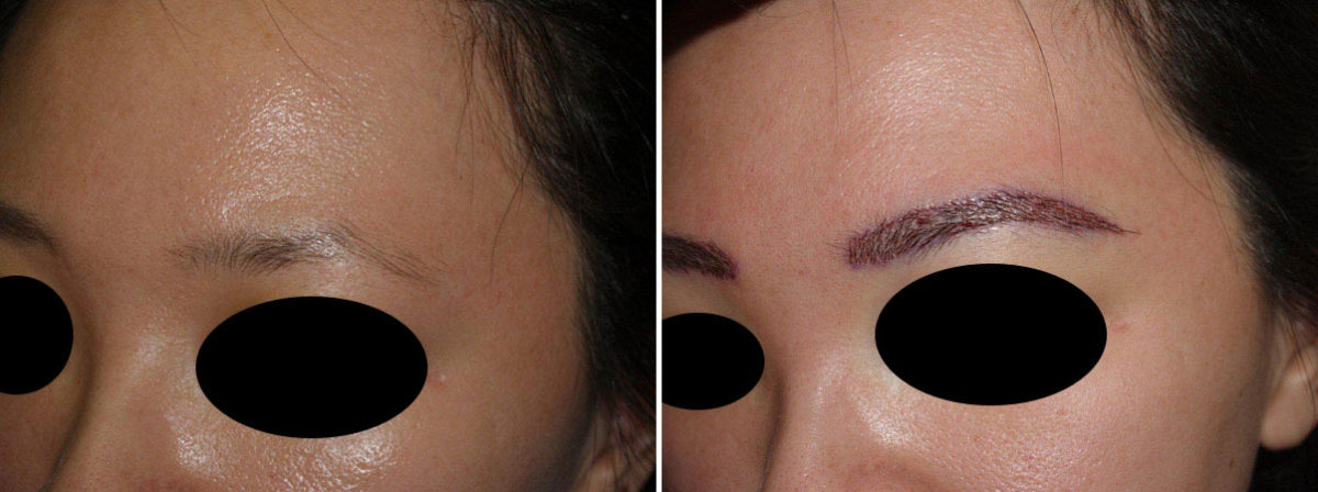 Eyebrow Transplantation before and after photos in Miami, FL, Patient 16529