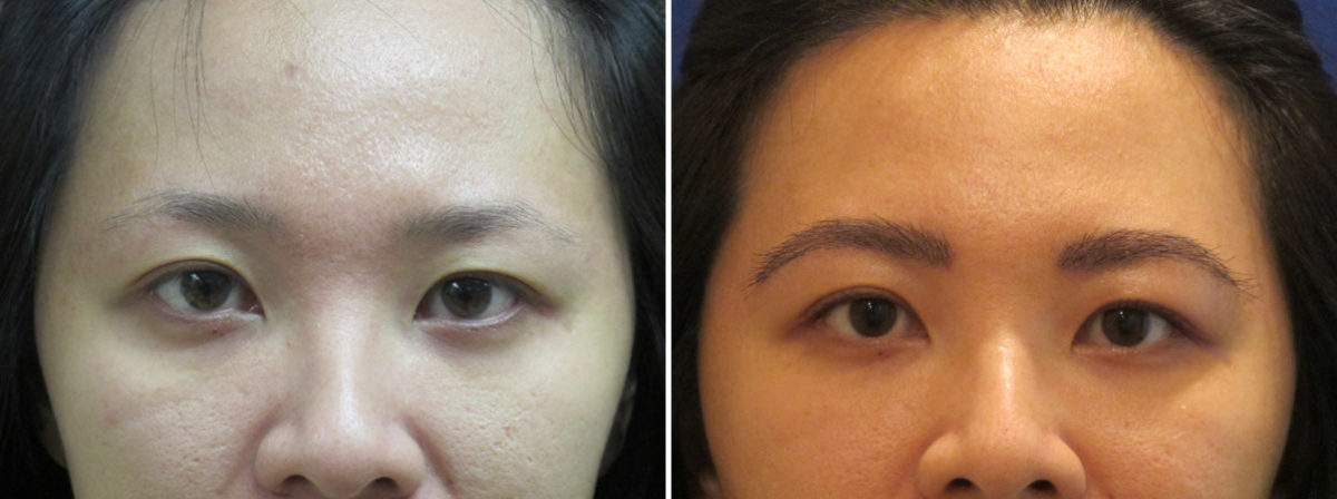 Eyebrow Transplantation before and after photos in Miami, FL, Patient 16534