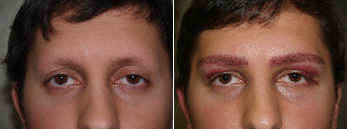 Eyebrow Transplantation before and after photos in Miami, FL, Patient 16541