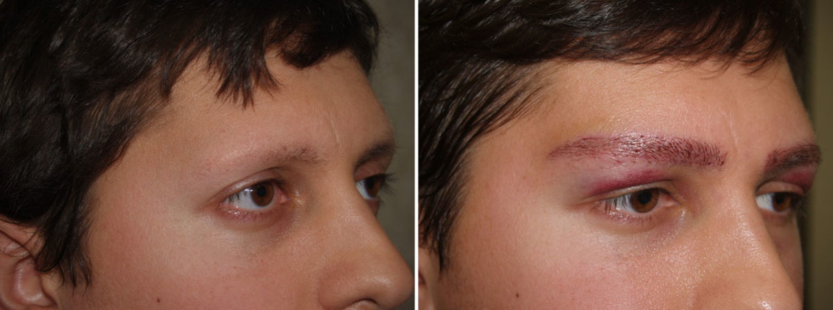 Eyebrow Transplantation before and after photos in Miami, FL, Patient 16541