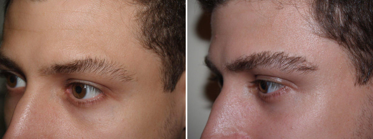 Eyebrow Transplantation before and after photos in Miami, FL, Patient 16553