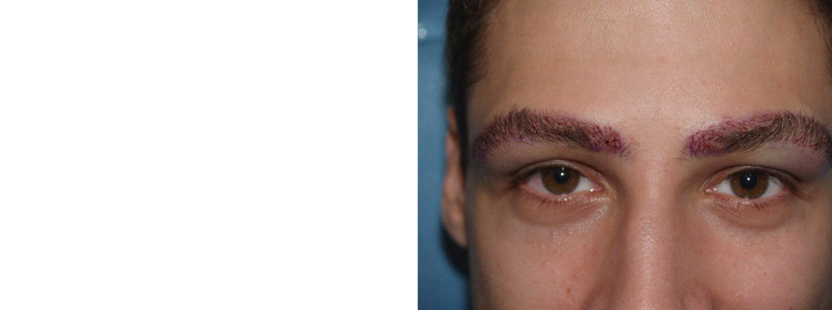 Eyebrow Transplantation before and after photos in Miami, FL, Patient 16553