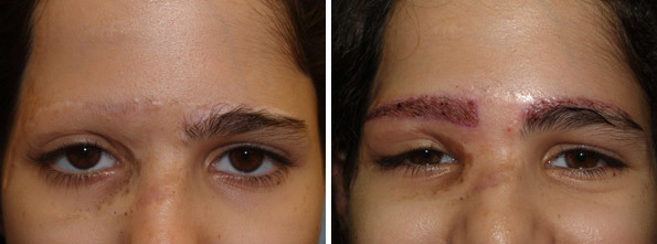 Eyebrow Transplantation before and after photos in Miami, FL, Patient 16566