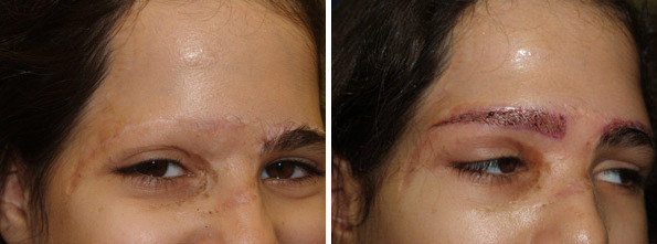 Eyebrow Transplantation before and after photos in Miami, FL, Patient 16566