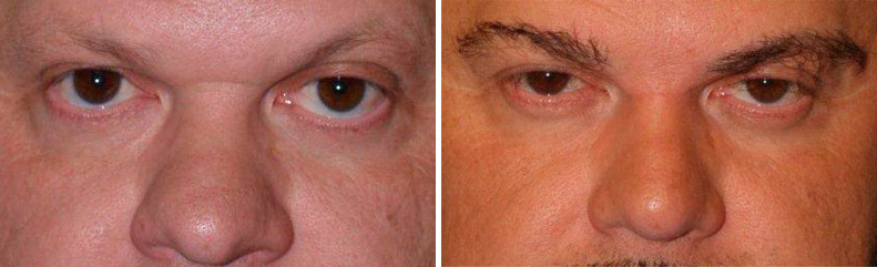Eyebrow Transplantation before and after photos in Miami, FL, Patient 16573