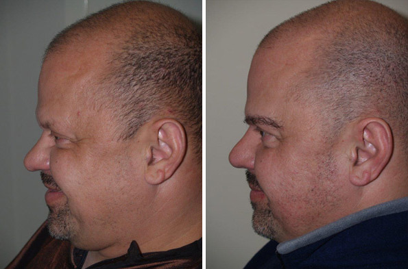 Eyebrow Transplantation before and after photos in Miami, FL, Patient 16573