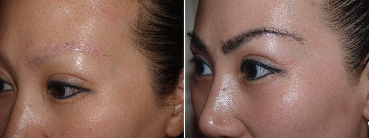 Eyebrow Transplantation before and after photos in Miami, FL, Patient 16575