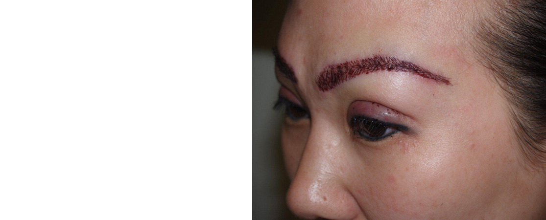 Eyebrow Transplantation before and after photos in Miami, FL, Patient 16575