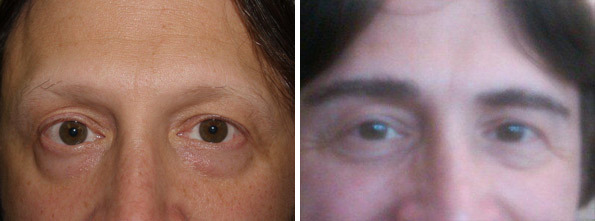 Eyebrow Transplantation before and after photos in Miami, FL, Patient 16597