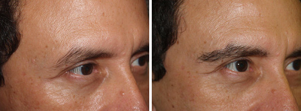 Eyebrow Transplantation before and after photos in Miami, FL, Patient 16600