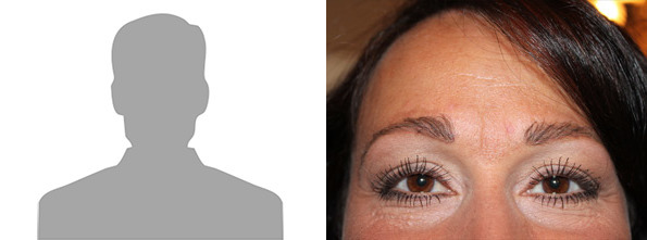 Eyebrow Transplantation before and after photos in Miami, FL, Patient 16607