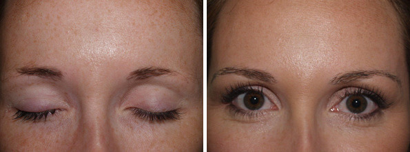 Eyebrow Transplantation before and after photos in Miami, FL, Patient 16612