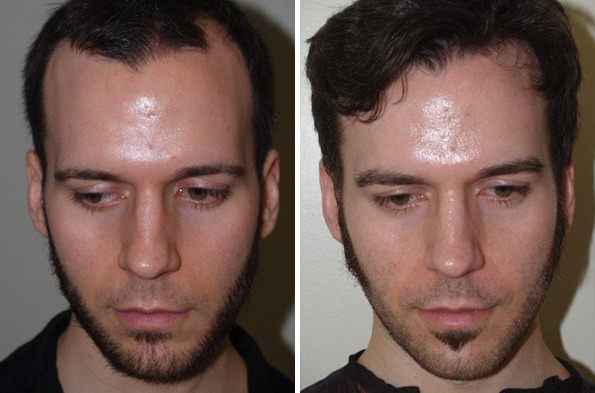 Eyebrow Transplantation before and after photos in Miami, FL, Patient 16617