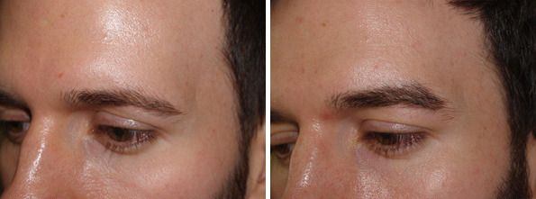 Eyebrow Transplantation before and after photos in Miami, FL, Patient 16617