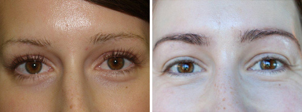 Eyebrow Transplantation before and after photos in Miami, FL, Patient 16624