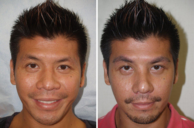 Eyebrow Transplantation before and after photos in Miami, FL, Patient 16627