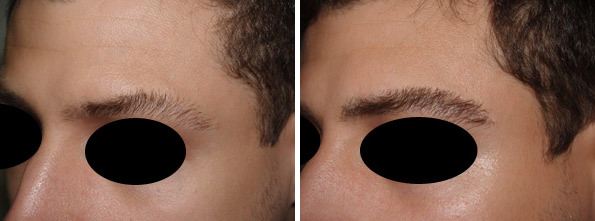 Eyebrow Transplantation before and after photos in Miami, FL, Patient 16630