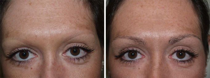 Eyebrow Transplantation before and after photos in Miami, FL, Patient 16637