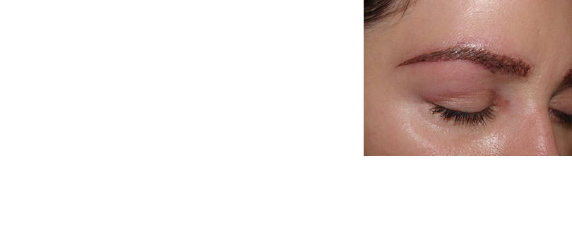 Eyebrow Transplantation before and after photos in Miami, FL, Patient 16651