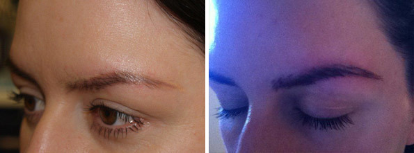 Eyebrow Transplantation before and after photos in Miami, FL, Patient 16651