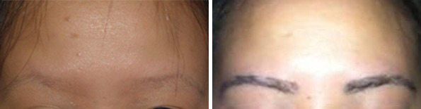 Eyebrow Transplantation before and after photos in Miami, FL, Patient 16660