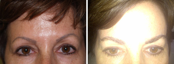 Eyebrow Transplantation before and after photos in Miami, FL, Patient 16663
