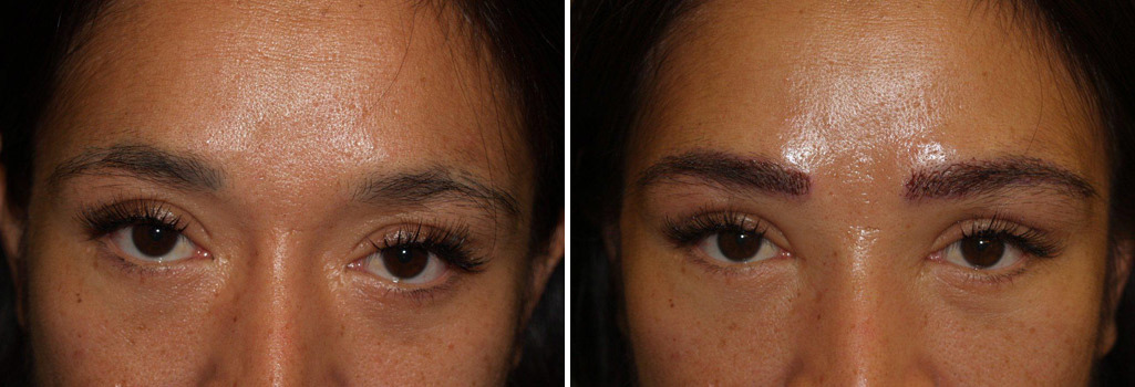 Eyebrow Transplantation before and after photos in Miami, FL, Patient 16666