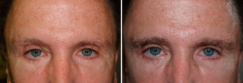 Eyebrow Transplantation before and after photos in Miami, FL, Patient 16674