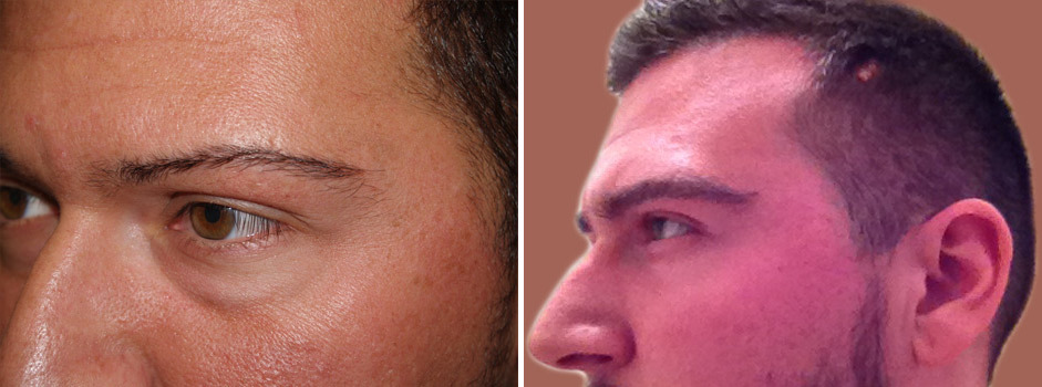 Eyebrow Transplantation before and after photos in Miami, FL, Patient 16677