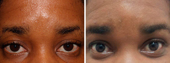 Eyebrow Transplantation before and after photos in Miami, FL, Patient 16682