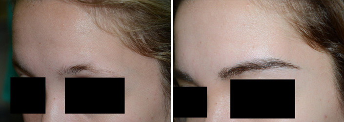 Eyebrow Transplantation before and after photos in Miami, FL, Patient 16685