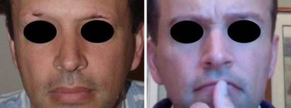 Eyebrow Transplantation before and after photos in Miami, FL, Patient 16692