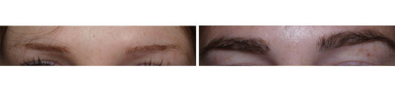 Eyebrow Transplantation before and after photos in Miami, FL, Patient 16695