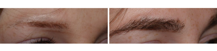 Eyebrow Transplantation before and after photos in Miami, FL, Patient 16695